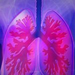 Common asbestos lung disease does not increase risk of lung cancer