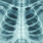 Australia’s lung cancer screening promise at risk, Curtin researcher warns